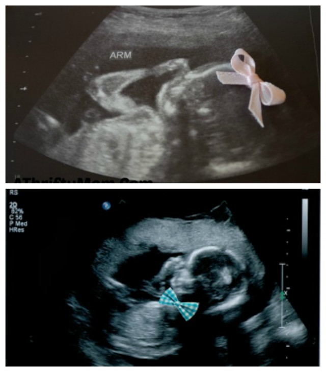 bows on ultrasound